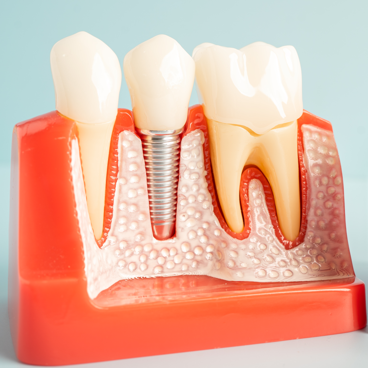 Dental Implant (Small icon on the main page) Dental Implant (Small icon on the main page)