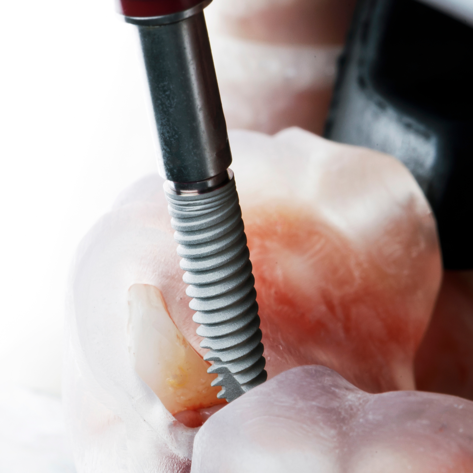 Dental Implant Dental Implant